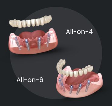 All-on-4/All-on-6 Implants